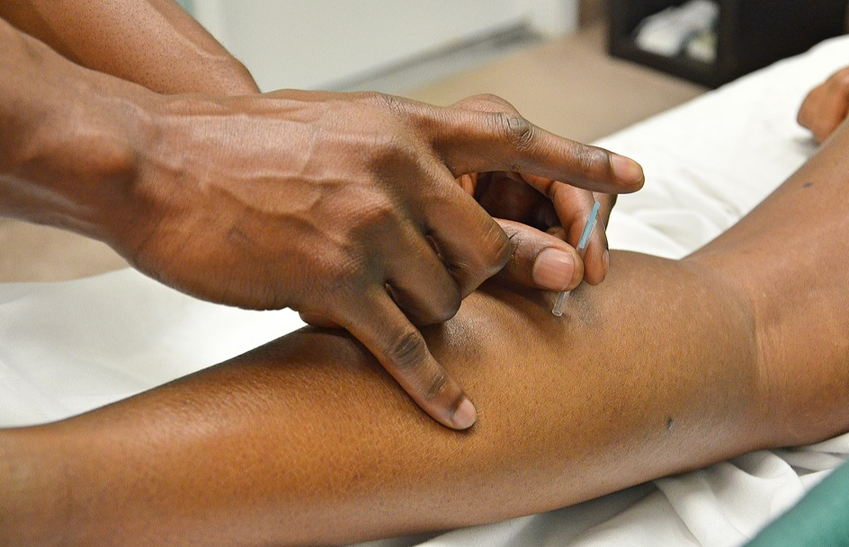 acupuncture